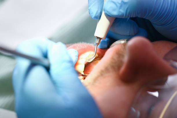 Best After-Hours Emergency Dentist in Monte Sereno, CA